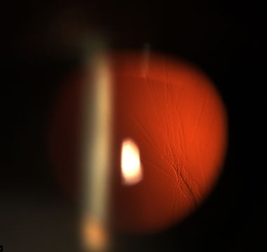 Spaltlampenfoto mit Darstellung der faltigen rückwärtigen Glaskörperrinde; sie verursacht Lichtstreuung und entoptische Phänomene.