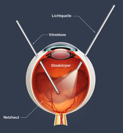 Augen-OP: Vitrektomie mit Einführung der Instrumente in das Innere des Auges.