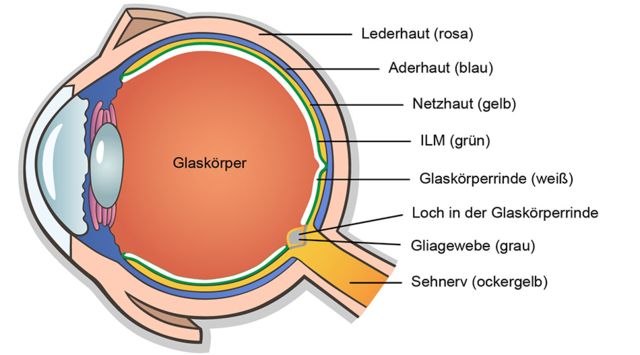 Sagittalschnitt Auge, anliegender gesunder Glaskörper in Gelform, ohne Kollagenverklumpungen