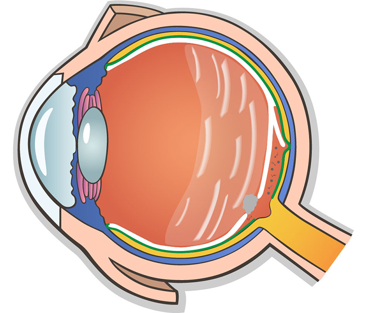 Querschnitt Auge mit freischwimmenden Faserpartikeln im retrovitrealen Raum nach Glaskörperabhebung, Grafik